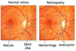 Diabetic retinopathy