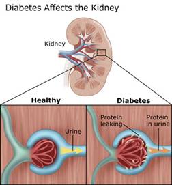 Diabetic kidney damage