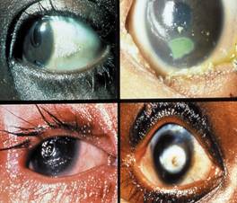 vitamin a deficiency blindness